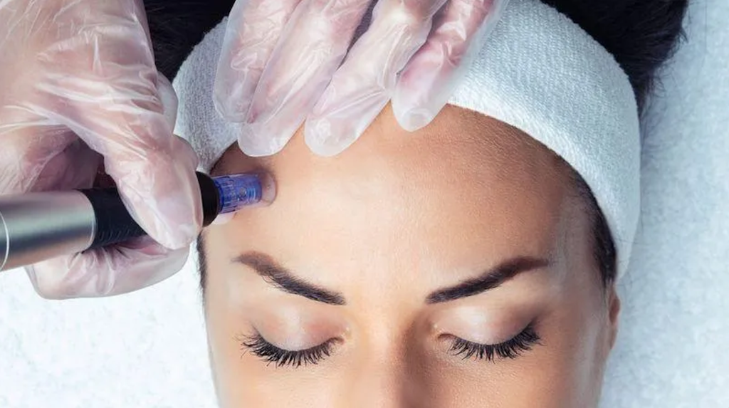 Microneedling-West-Bloomfield-Township-MI